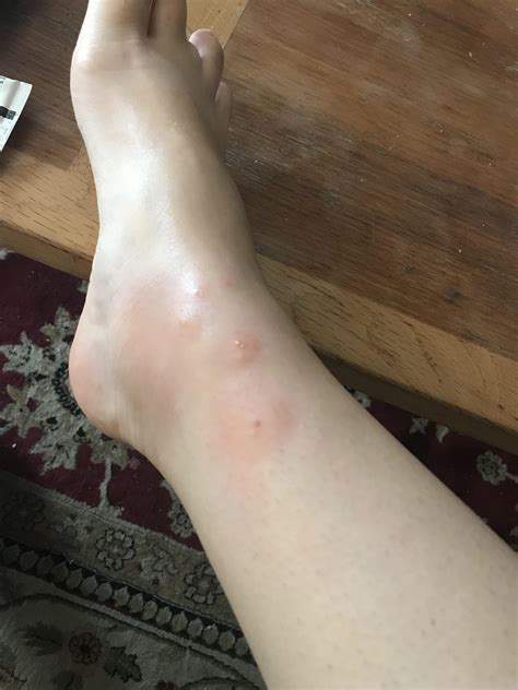 red fire ants bites